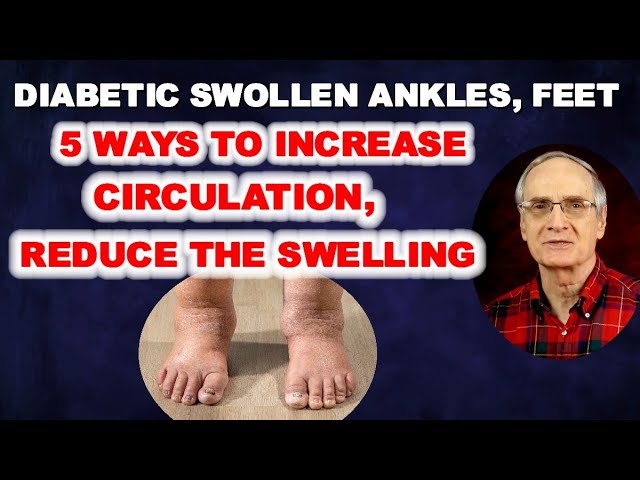 Swollen Ankles, Puffy Feet – 5 Ways for Diabetics to Increase Circulation