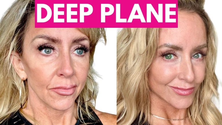 Why I Got A Facelift (And Why I’m Not Sorry!)